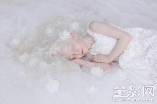 摄影师为白化病人拍唯美大片视频 白化病人拍的照片